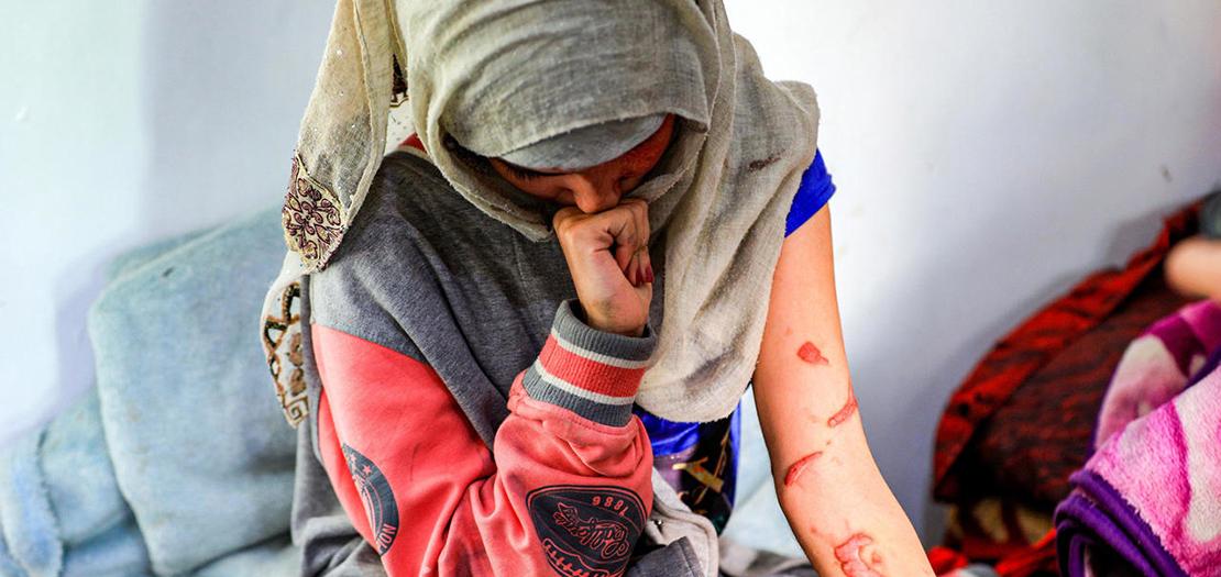 اليمنية العنود حسين شريان المشوهة الوجه بعد ان سكب زوجها السابق عليها الأسيد، 28 كانون الثاني 2021