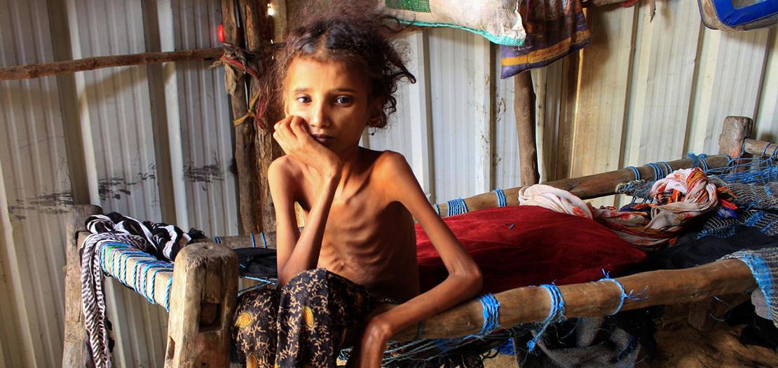 طفلة يمنية تبلغ 10 سنوات وتعاني من سوء التغذية الحاد في حجة، 23 كانون الثاني 2021