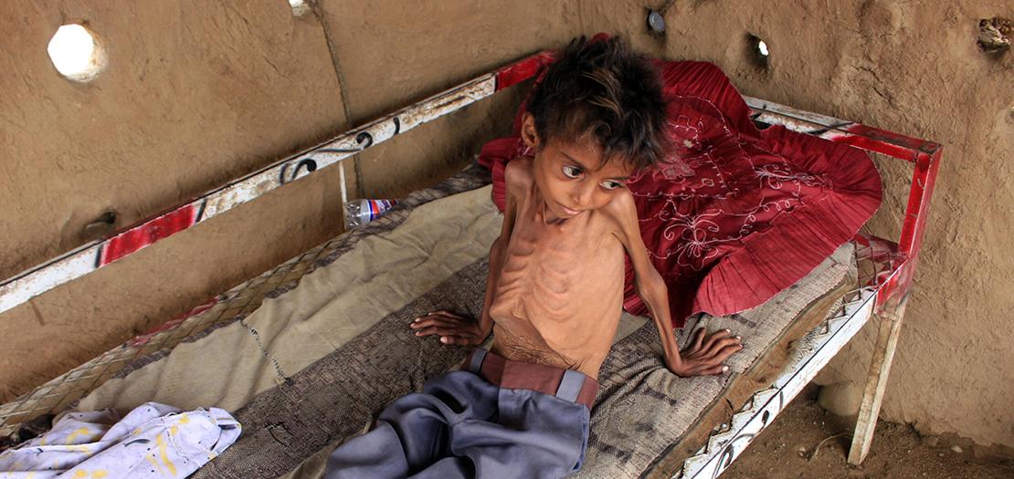 طفل في العاشرة يعاني من سوء تغذية شديد في عبس في اليمن، 25 تموز 2022