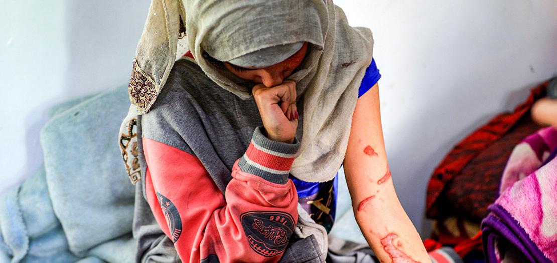 اليمنية العنود حسين شريان المشوهة الوجه بعد ان سكب زوجها السابق عليها الأسيد في صورة التقطت في 28 كانون الثاني 2021